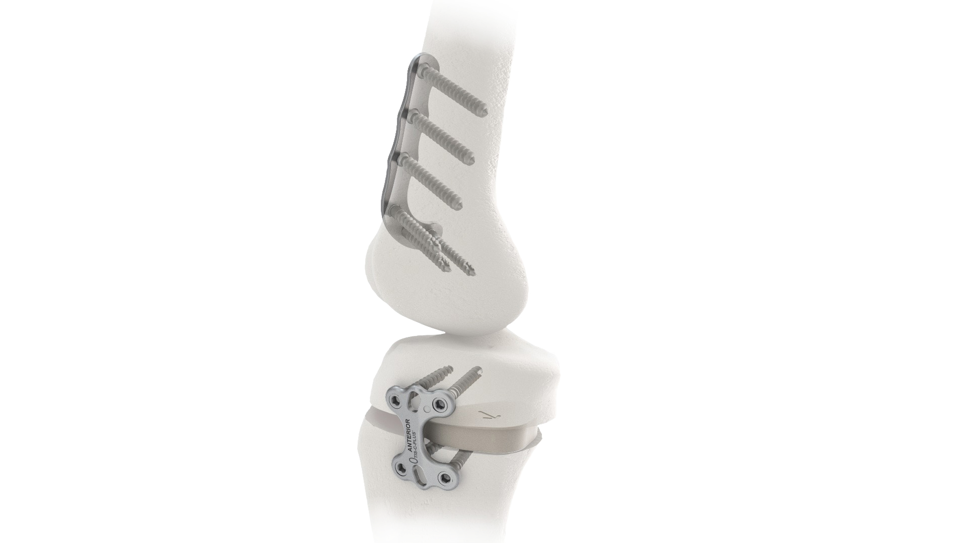 SBM Osteotomies around the knee